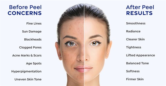 Curious about Peels? Photo